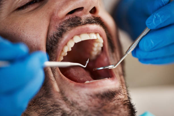 Best Emergency Dental Care for Broken or Chipped Teeth in Ontario, CA